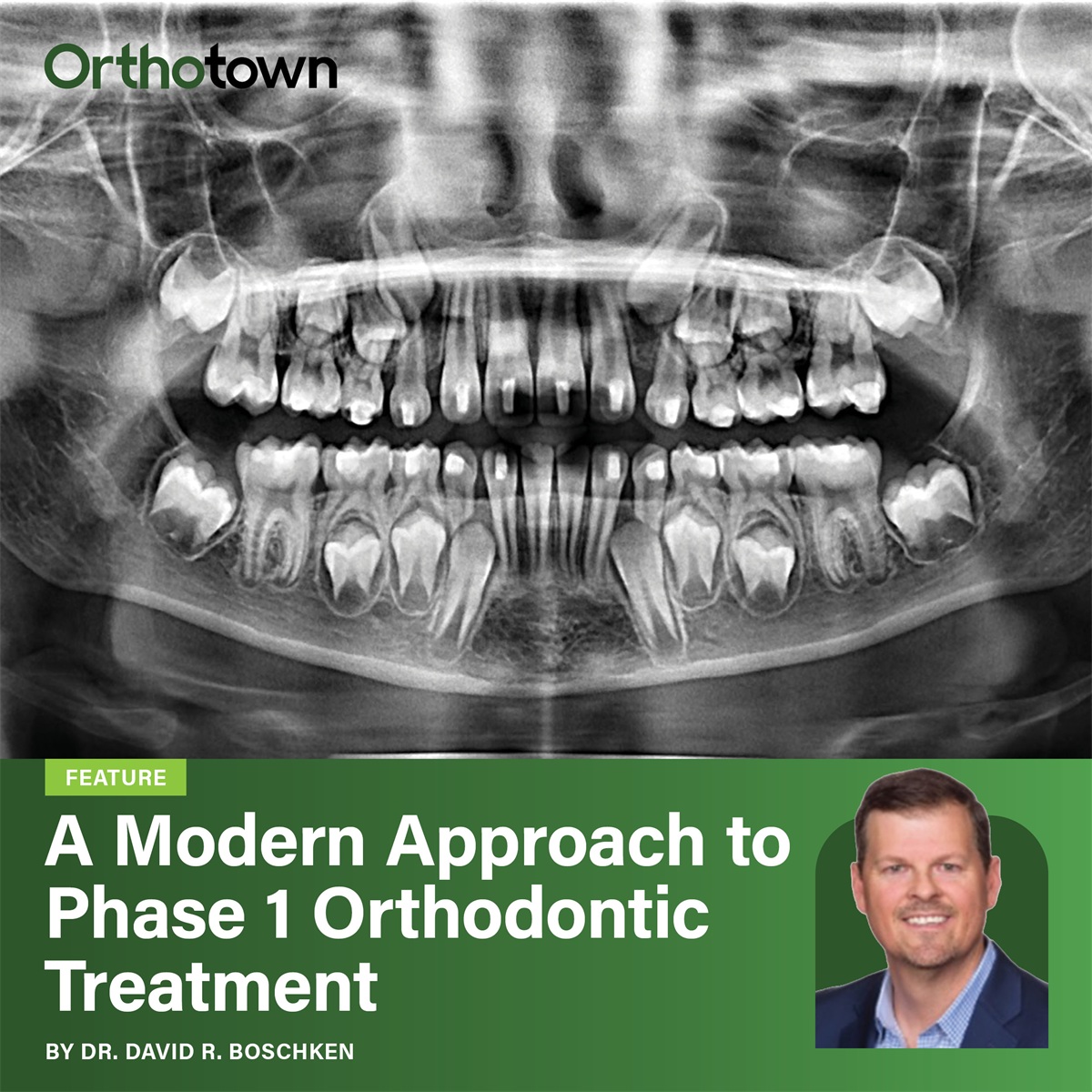 A Modern Approach to Phase 1 Orthodontic Treatment Dr. David R. Boschken presents a Phase 1 case combining clear palatal expansion and
aligner therapy, completed in just over 10 months.