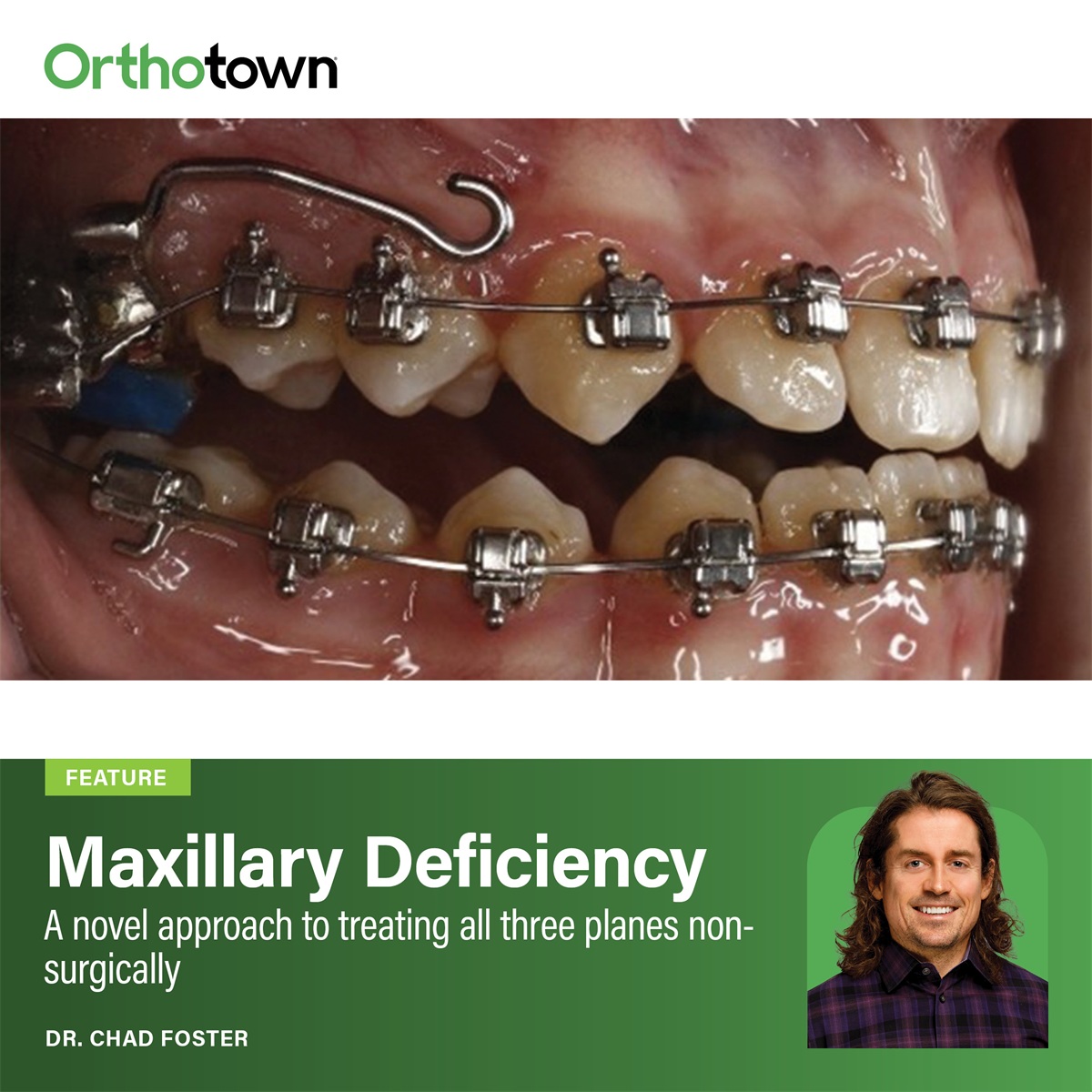 Maxillary Deficiency Dr. Chad Foster introduces a custom MARPE design that nonsurgically addresses
maxillary deficiency in all three planes (transverse, anteroposterior, and vertical) in a
single treatment phase.