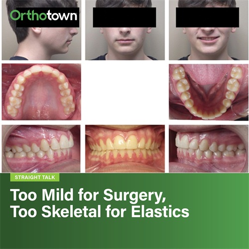 Too Mild for Surgery, Too Skeletal for Elastics 