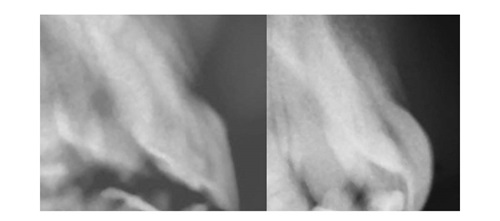 A Voice in the Area: Maxillary Central Incisor Labial Surface Shape Editorial director Dr. Chad Foster shares a case study that illustrates the importance of the aesthetics of the maxillary anterior teeth.