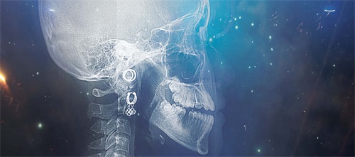 Iatrogenic Challenges Dr. Adith Venugopal and Dr. Can-Florian Keles discuss iatrogenic failures and clinical tips on how to correct them, sharing a couple of cases about their own experiences in this topic.