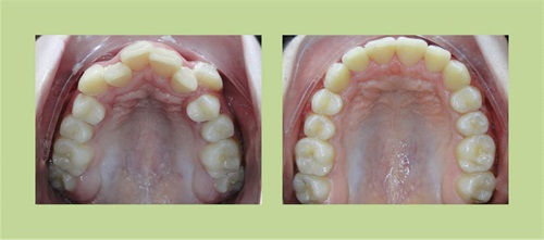 Townie Treatment Case: Non-Extraction Treatment Plan Dr. Zvi Kennet shares a patient case that illustrates his practice philosophy, which eschews rapid palatal expanders, headgear or facemasks and opts instead for a variety of smart devices that can be combined to address each patient’s unique situation—and in almost all cases without bicuspid extractions. 