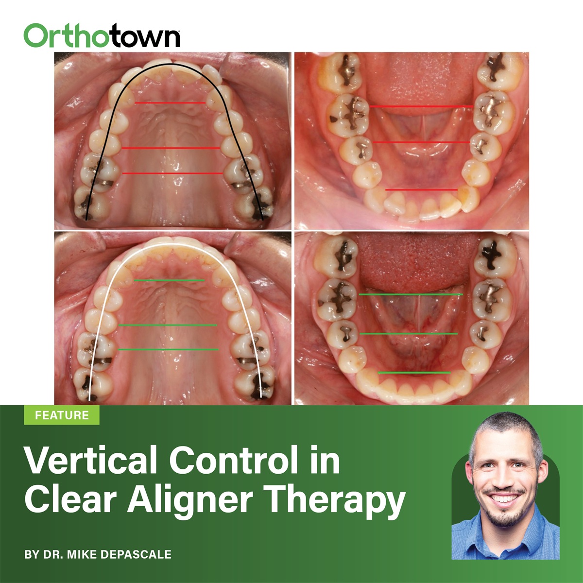 Vertical Control in Clear Aligner Therapy Dr. Mike DePascale outlines staging protocols for managing open bites and deep bites with clear aligners, addressing common misconceptions about aligner limitations
compared to braces.