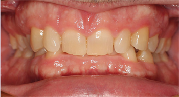 CE: In for the Save:  Applications of Manual Osteoperforation In this in-depth course, Dr. R. Bruce McFarlane describes how manual osteoperforation can be applied in cases being treated with fixed brackets or clear aligners.