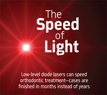 The Speed of Light Dr. John Hendy discusses how using lasers can help expedite orthodontic treatment.