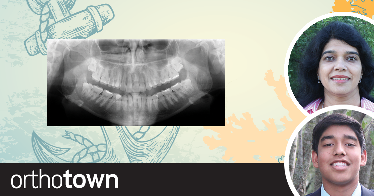Anchors Aweigh Dr. Saritha Chary-Reddy and Karthik Reddy share a case of microscrew-assisted Class II correction in an adult patient.