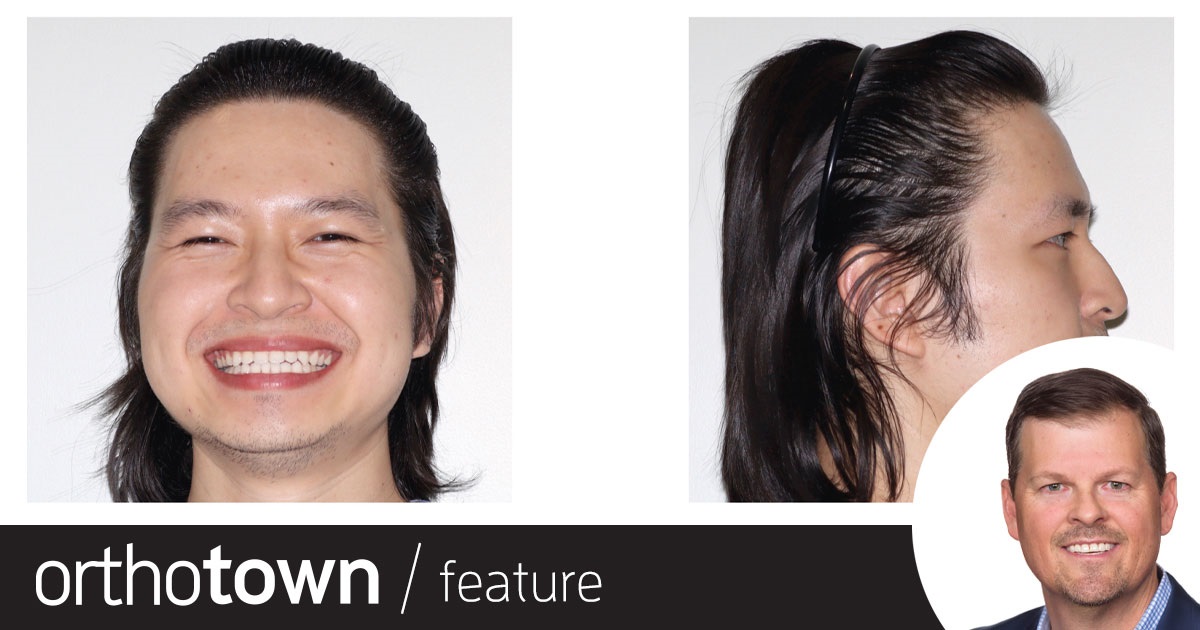 Townie Treatment Case: A Team Approach Dr. David R. Boschken treats a complex Class III case with segmented clear aligners, elastics, high-frequency vibration and virtual visits.
