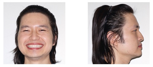 Townie Treatment Case: A Team Approach Dr. David R. Boschken treats a complex Class III case with segmented clear aligners, elastics, high-frequency vibration and virtual visits.