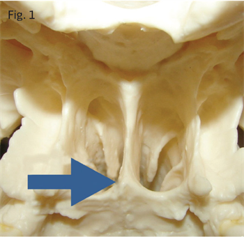 A Winning Combination Dr. John Pobanz shares two case studies in which CBCT images helped him determine the best placement for miniscrews in the midpalatal suture.