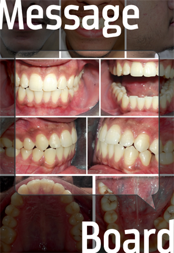 Extraction or Non? A handful of treatment options for a common case, and an example that not every doc takes the same road to the finish.