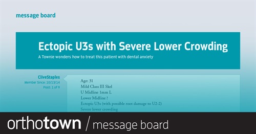 Ectopic U3s with Severe  Lower Crowding A Townie wonders how to treat this patient with dental anxiety.