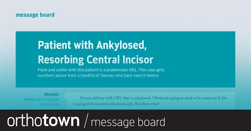 Patient with Ankylosed,  Resorbing Central Incisor Front and center with this patient is a problematic UR1. This case gets excellent advice from a handful of Townies who’ve seen the same situation before.
