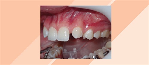 Cuspid Substitutions Dr. Robert “Tito” Norris shares techniques for predictable excellence when using a cuspid to replace a missing maxillary lateral incisor. His step-by-step guide is accompanied by a case study, and key considerations to optimize the aesthetics and function of this treatment option.