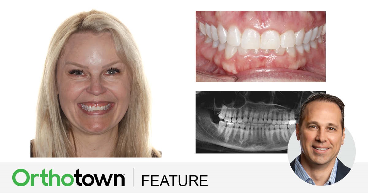 Townie Treatment Case: TADs, Clear Aligners and Overkill