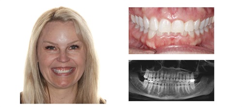 Townie Treatment Case: TADs, Clear Aligners and Overkill Dr. Bill Dischinger presents an early case in which he used TADs and clear aligners to treat a patient who had an open bite and a gummy smile—and inadvertently burned out the patient in his attempt to achieve an absolutely perfect smile.