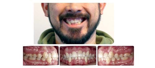 A Voice in the Arena: Early Cant Protocol: Asymmetric Bite Turbos and Elastics Editorial director Dr. Chad Foster shares a bite turbo and elastic pairing that he’s found works well for mild anterior cants.