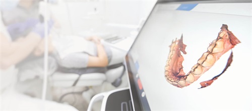 Unparalleled Accuracy Dr. Bryan Lockhart shares a case in which he used digital treatment planning, custom fixed appliances and indirect bonding to eliminate what he refers to as “operator eye bias” when placing brackets. 