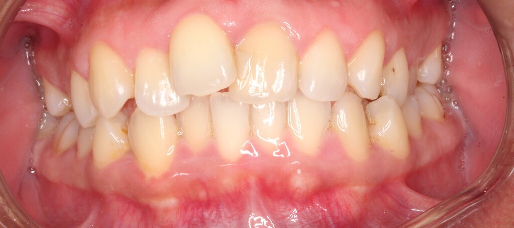 Treating Around Teeth That May Not Survive