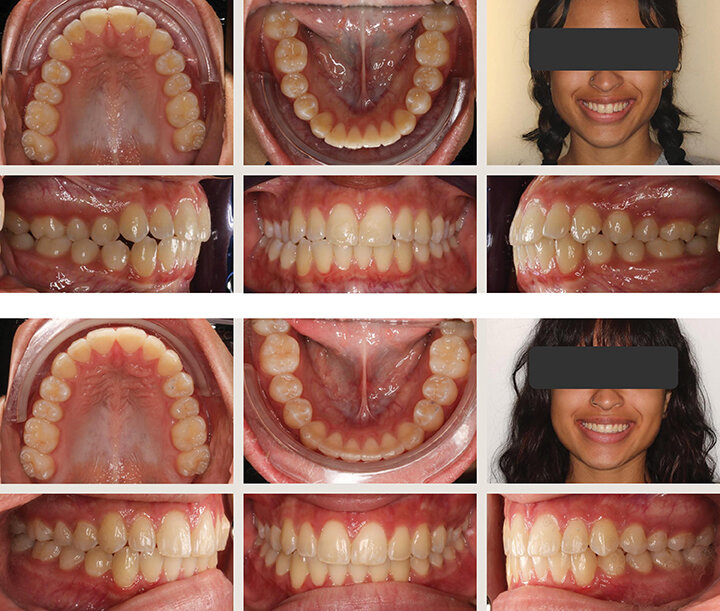 Emerging Principles of Modern Clear Aligner Mechanics