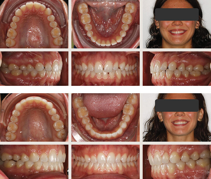 Emerging Principles of Modern Clear Aligner Mechanics
