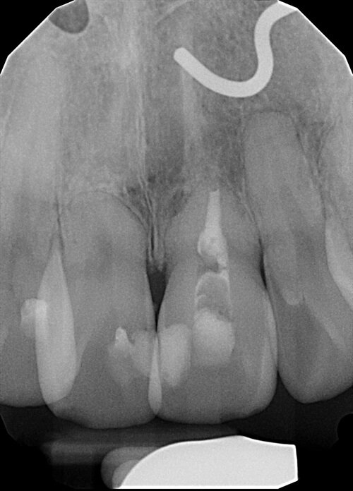 Treating Around Teeth That May Not Survive