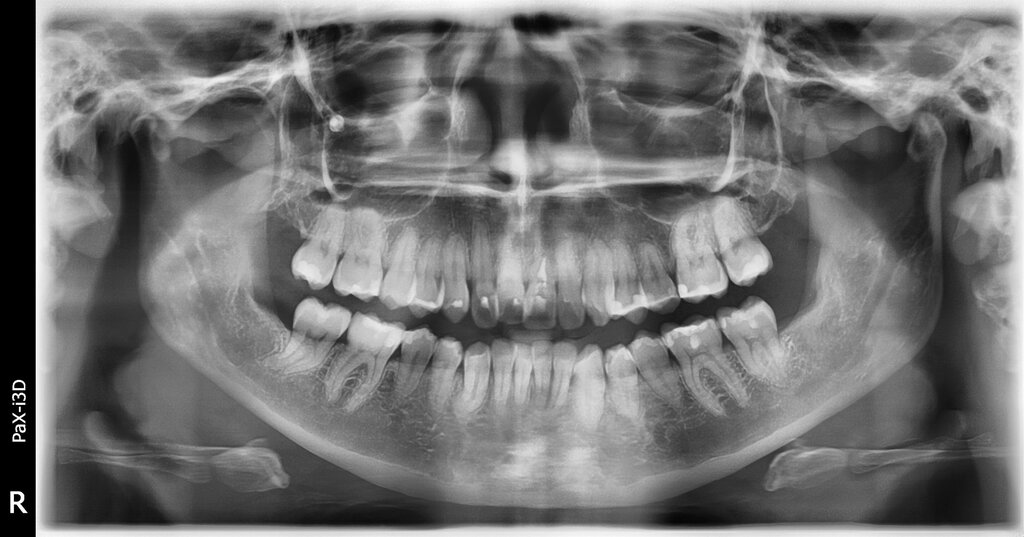 Treating Around Teeth That May Not Survive
