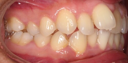 Treating Around Teeth That May Not Survive