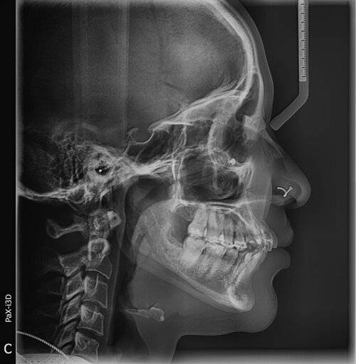 Treating Around Teeth That May Not Survive