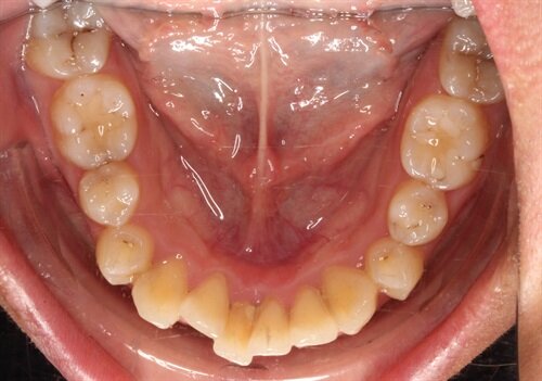 Treating Around Teeth That May Not Survive