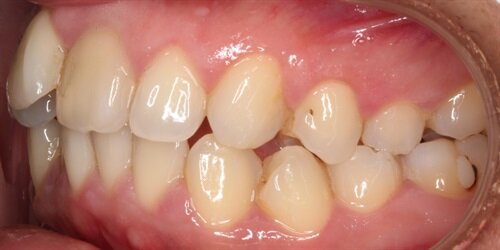 Treating Around Teeth That May Not Survive