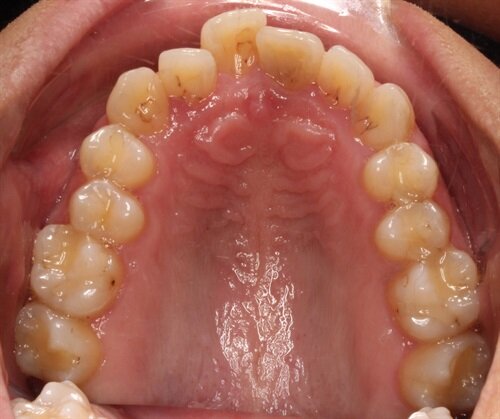Treating Around Teeth That May Not Survive