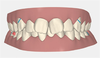 Good Vibrations With vibration technology, aligner patients are partners in their own progress—and cut their treatment  time significantly