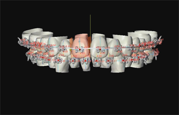 Indirect Bonding: The Tech Effect Dr. Jack Fisher writes about the new tech-friendly era and how today’s 3-D advancements are the future of orthodontic treatment and planning.