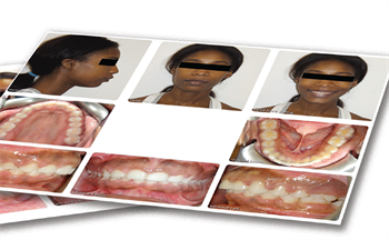 Interdisciplinary Ortho-Perio Treatment of Excessive Gingival Display In this case study, Dr. Edmund Khoo and his colleagues show how orthodontics and periodontics work together to beautifully improve a patient’s gummy smile.