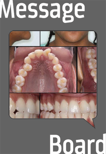 Clinical Orthodontics: HSD/Invisalign/Adult A Townie shares a well-documented case involving Invisalign and HSD.