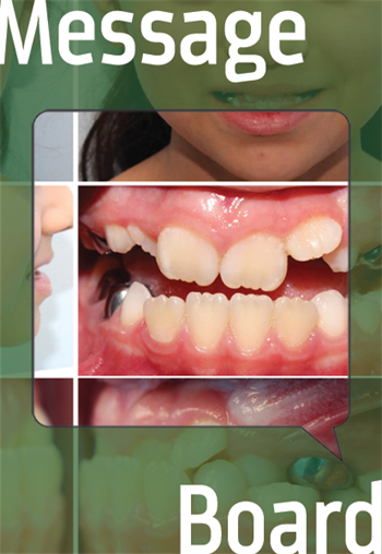 Phase 1: Anterior Crossbite and Crowding Fixing a crossbite can be tricky. Orthos weigh in on their different techniques for what works and what doesn’t.