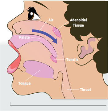 Continuing Education: Changing Lives, One Airway  at a Time Dr. Manjari Kulkarni of GKG Orthodontics discusses how orthodontic treatment with rapid palatal expansion may improve both orthodontic malocclusion and symptoms of airway resistance in young patients.