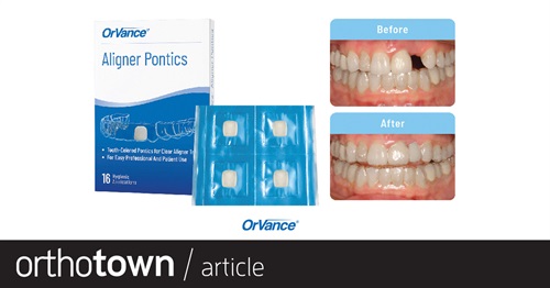 Product Profile: Aligner Pontics Curing the pontics headache