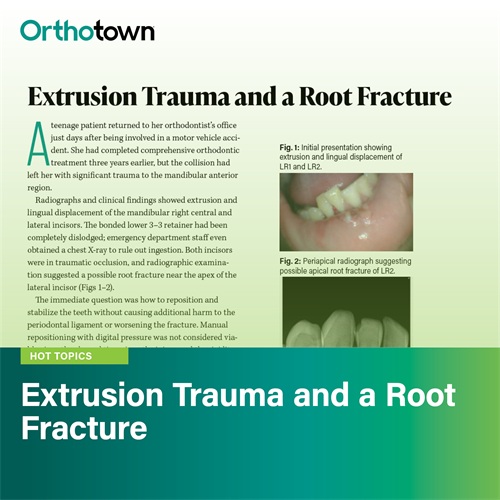 Straight Talk: Extrusion Trauma and a Root Fracture Townies discuss managing a teenage patient’s dental trauma after a car accident, using light orthodontic mechanics and splinting to reposition extruded incisors, with emphasis on endodontic care and long-term follow-up.