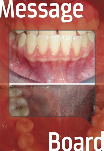 Message Board: Class III Case with Unilateral Missing Lateral A young girl gives this doc a challenge in choosing the correct treatment plan. Which option seems best?