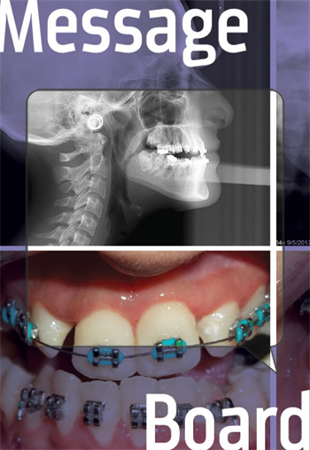 What Can I Do for This Case? A seemingly difficult Class III case involving a bilateral posterior open bite and extracted U4s.