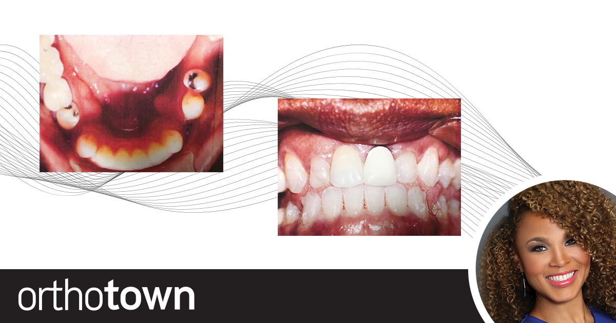 The Need for Speed Dr. Heather Brown shares case studies that demonstrate the use of vibrational technologies to speed orthodontic treatment.