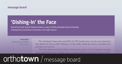 ‘Dishing-In’ the Face One of our most active Townies shares a case in which premolars were extracted, showing that
sometimes extraction is the right answer.