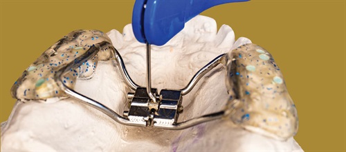 CE: Expand Your Reality Dr. Michael K. DeLuke discusses slow maxillary expansion options, which patients would benefit most from such treatment and more.