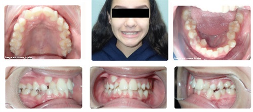 Townie Treatment Case: Changing a Smile (And a Life) Dr. Bryan Nakfoor shares a case study of a patient he treated as part of the Smiles Change Lives program.