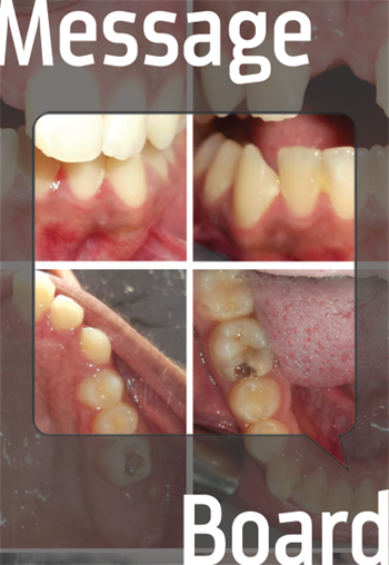 Can I Close This Space Orthodontically with Reshaping? A patient with poor oral hygiene wants to close a space between his teeth. Is it wise to treatment plan before he improves his oral hygiene?