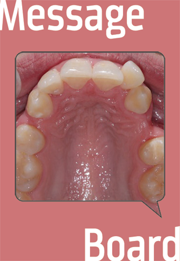 Clinical Orthodontics: Trouble Closing Extraction Space? One Townie’s challenge leads to others sharing their cases.