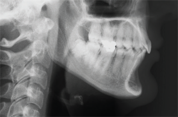 The Proven Merits of Molar Removal Orthotown Editorial Director Dr. Dan Grob shares an interesting case report on secondary molar extraction.