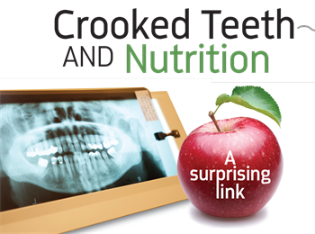 Crooked Teeth and Nutrition Dr. Steven Lin discusses the role of patient nutrition in craniofacial growth and development. How early could it start to affect a child’s  teeth, jaws and airway?