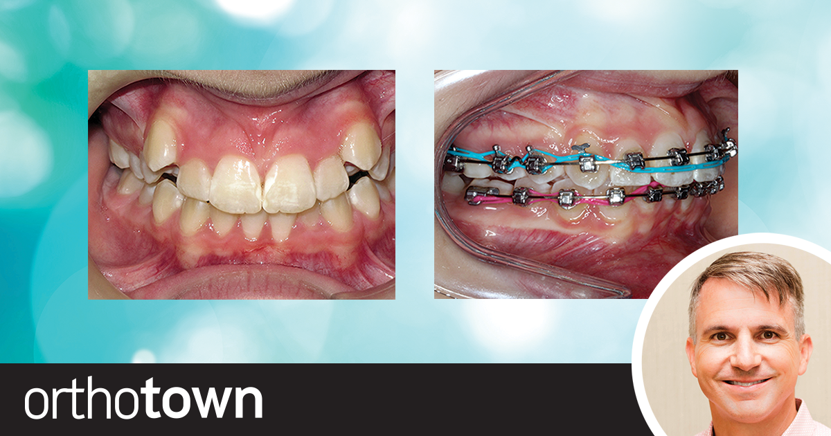 Passive Ligation, Active Results Dr. Todd Bovenizer explains the benefits of passive self-ligating brackets and shares some case studies in which he treated patients who may have had the tendency to result in bimaxillary protrusion.